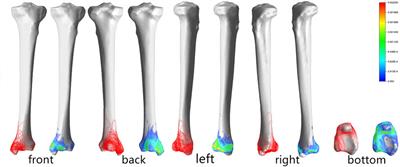 Evaluation of Ankle Fractures in 228 Patients From a Single Center Using Three-Dimensional Computed Tomography Mapping